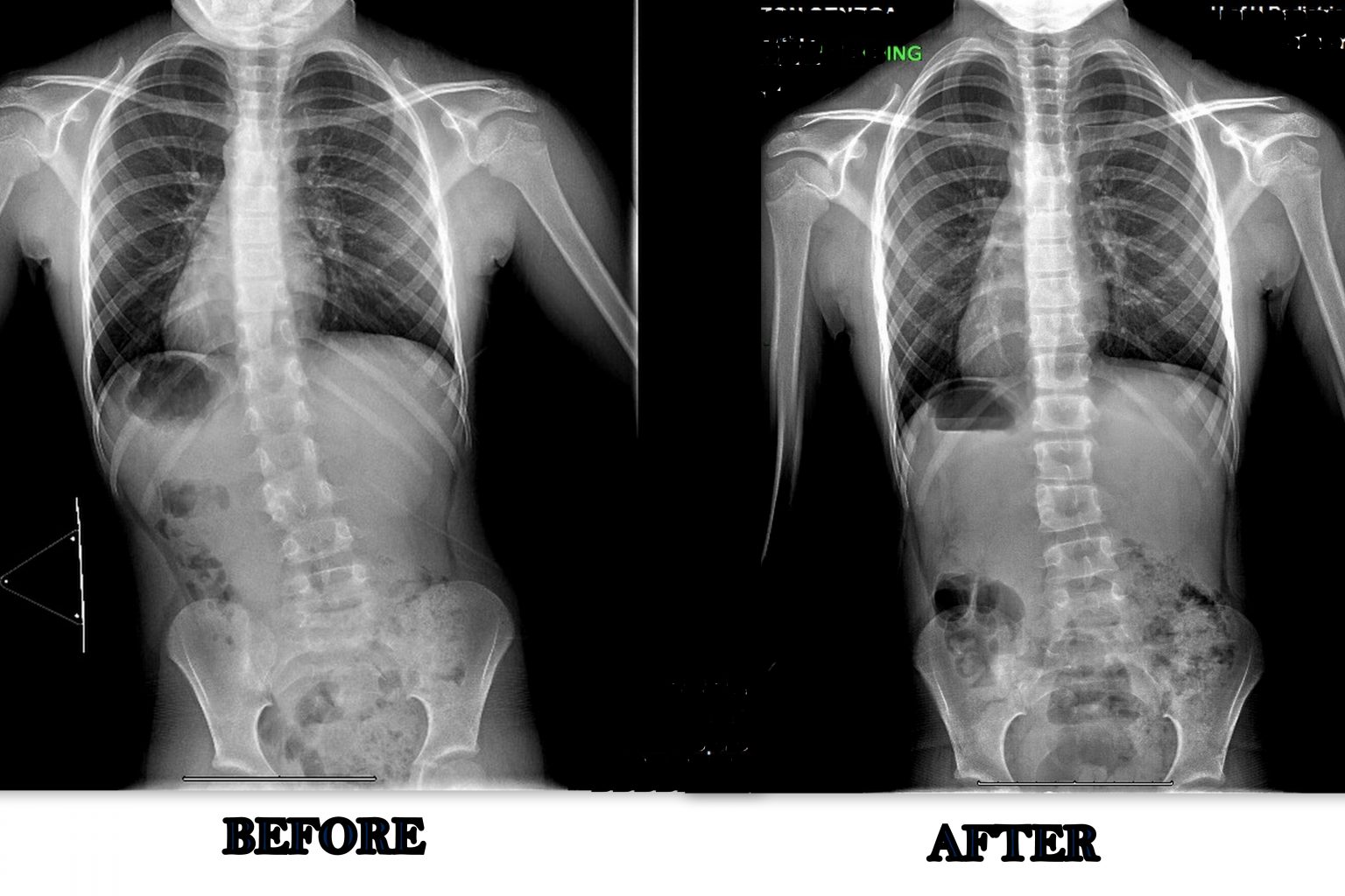 The Schroth Method for Scoliosis Explained Align Therapy Utah